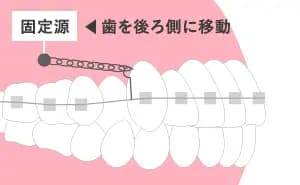 歯科矯正用アンカースクリューを使用した場合