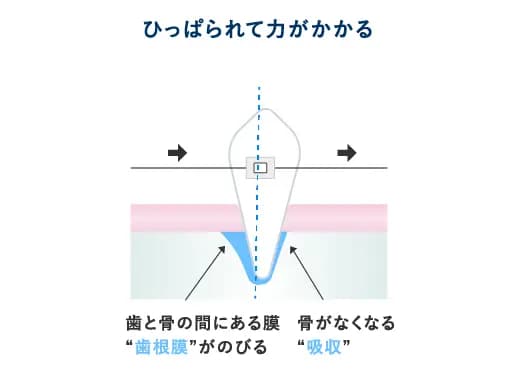 歯に力をかけると一方では歯根膜が伸び、反対側では骨が圧迫され少し溶けます。