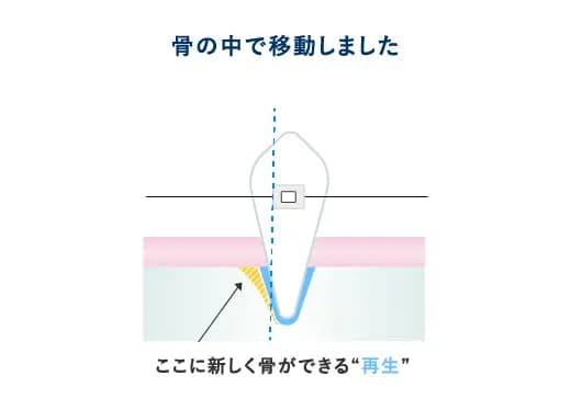 骨の移動が起こることによって生まれたスペースは、新たな骨によって修復されます。